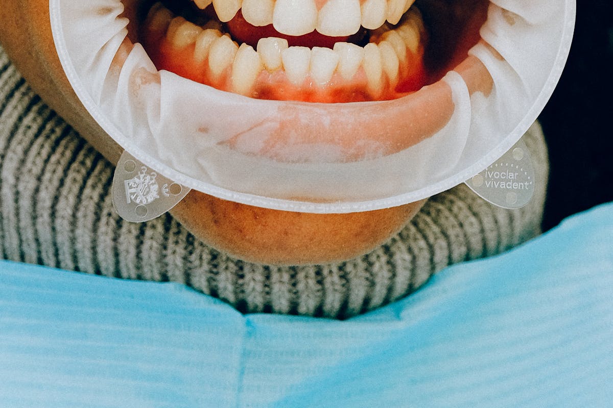 crowded teeth